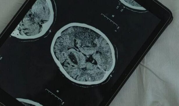 Estreno mundial.  Se encontró un gusano vivo en el cerebro de una mujer -Revista Interesante