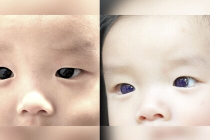 Los ojos marrón oscuro de un bebé de repente se vuelven azul índigo después del tratamiento antiviral COVID-19. ¿Pero por qué? -Revista Interesante