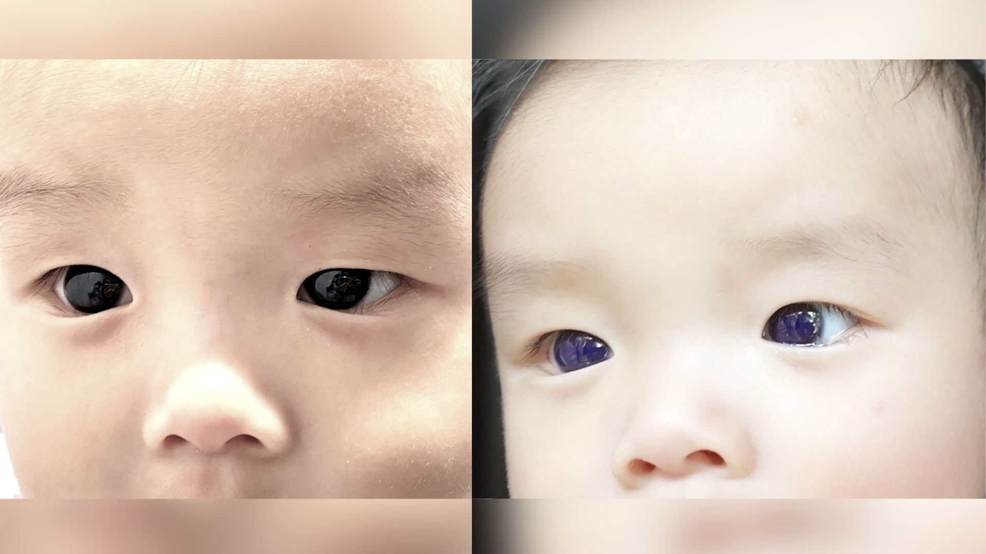 Los ojos marrón oscuro de un bebé de repente se vuelven azul índigo después del tratamiento antiviral COVID-19. ¿Pero por qué? -Revista Interesante