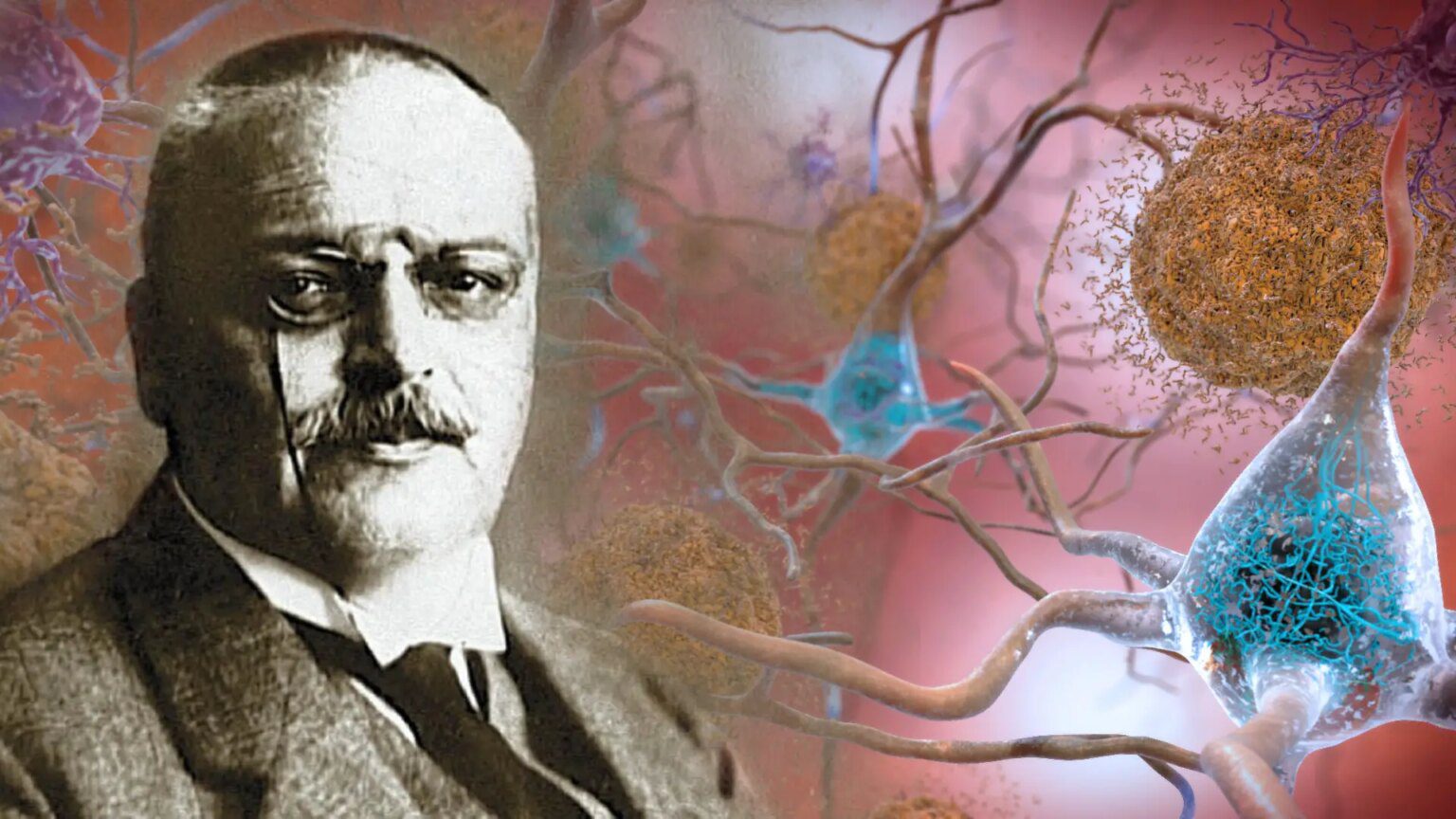 Alois Alzheimer: El hombre que descubrió la peor enfermedad neurodegenerativa en los ancianos -Revista Interesante