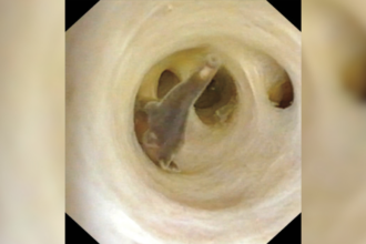 Observe cómo extraen gusanos parásitos del abdomen de un hombre después de un descubrimiento sorpresa durante una cirugía de rutina -Revista Interesante